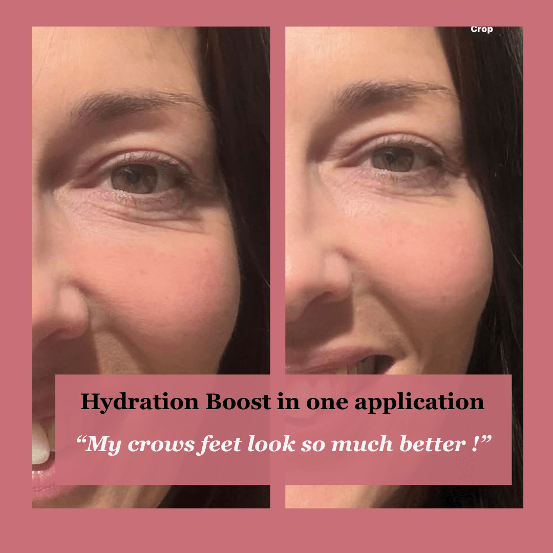 Before and after crow's feet results with Soft Baby